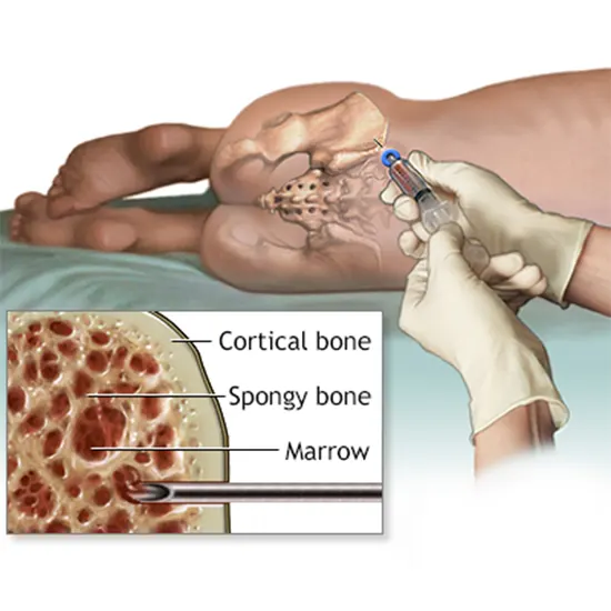 Bone Marrow Culture and Sensitivity